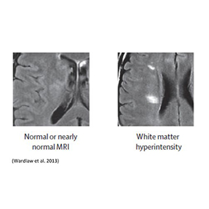 White matter disease exacts heavy toll. More evidence that damage to cognitive areas is widespread